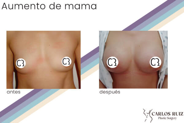 Dr. Carlos Ruiz Zepeda - Cirujano Plástico | Aumento de mama, caso 3, antes y después
