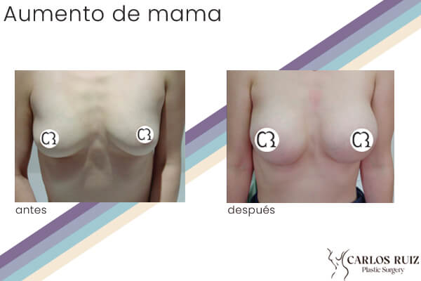 Dr. Carlos Ruiz Zepeda - Cirujano Plástico | Aumento de mama, caso 4, antes y después