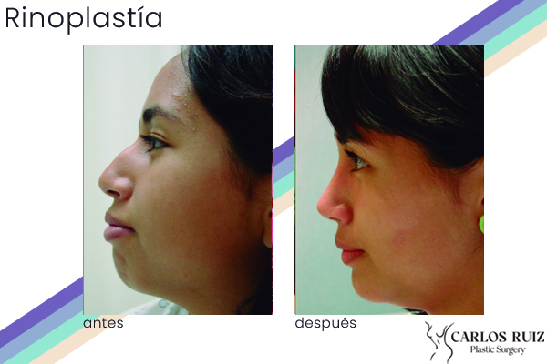 Dr. Carlos Ruiz Zepeda - Cirujano Plástico | Rinoplastía, caso 1, antes y después