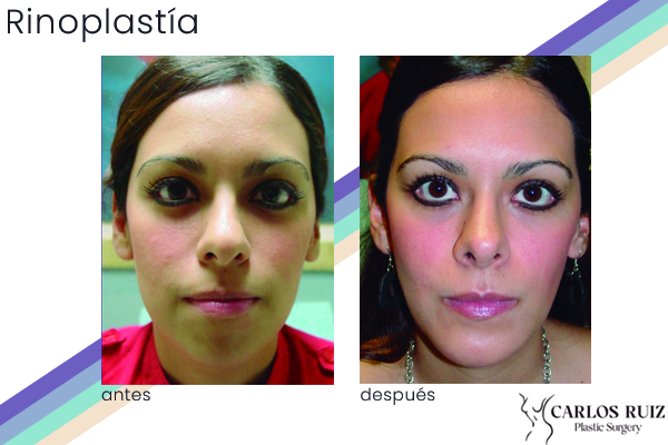 Dr. Carlos Ruiz Zepeda - Cirujano Plástico | Rinoplastía, caso 3, antes y después